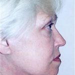 Facelift and Necklift Before & After Patient #1739