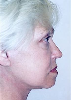 Facelift and Necklift Before & After Patient #1739