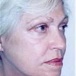 Facelift and Necklift Before & After Patient #1739