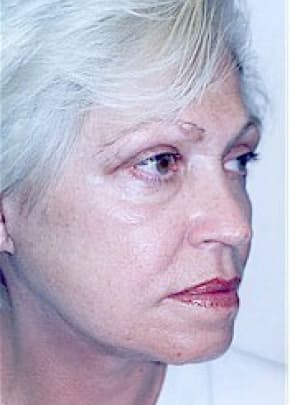 Facelift and Necklift Before & After Patient #1739