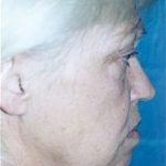Facelift and Necklift Before & After Patient #1739