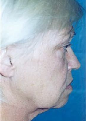 Facelift and Necklift Before & After Patient #1739
