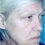 Facelift and Necklift Before & After Patient #1739