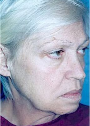 Facelift and Necklift Before & After Patient #1739