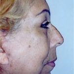 Facelift and Necklift Before & After Patient #1738