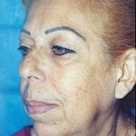 Facelift and Necklift Before & After Patient #1738