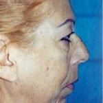 Facelift and Necklift Before & After Patient #1738