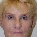 Facelift and Necklift Before & After Patient #1737