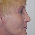 Facelift and Necklift Before & After Patient #1737