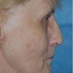 Facelift and Necklift Before & After Patient #1737