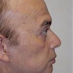 Facelift and Necklift Before & After Patient #1736