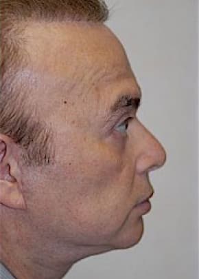 Facelift and Necklift Before & After Patient #1736