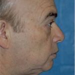 Facelift and Necklift Before & After Patient #1736