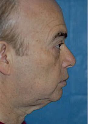 Facelift and Necklift Before & After Patient #1736