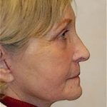 Facelift and Necklift Before & After Patient #1735