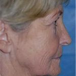 Facelift and Necklift Before & After Patient #1735