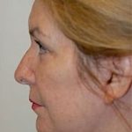 Facelift and Necklift Before & After Patient #1734