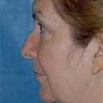 Facelift and Necklift Before & After Patient #1734