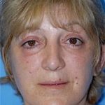 Facelift and Necklift Before & After Patient #1731