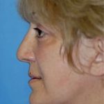 Facelift and Necklift Before & After Patient #1731