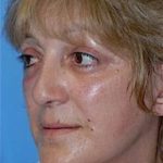 Facelift and Necklift Before & After Patient #1731