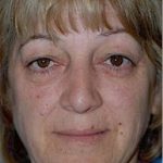 Facelift and Necklift Before & After Patient #1731