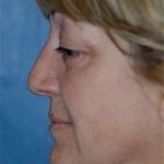 Facelift and Necklift Before & After Patient #1731