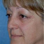Facelift and Necklift Before & After Patient #1731