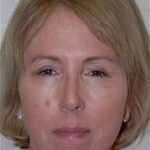 Facelift and Necklift Before & After Patient #1730