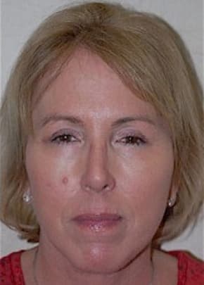 Facelift and Necklift Before & After Patient #1730