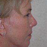 Facelift and Necklift Before & After Patient #1730