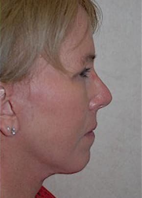 Facelift and Necklift Before & After Patient #1730