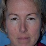 Facelift and Necklift Before & After Patient #1730