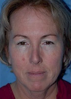 Facelift and Necklift Before & After Patient #1730