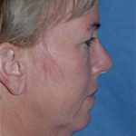 Facelift and Necklift Before & After Patient #1730