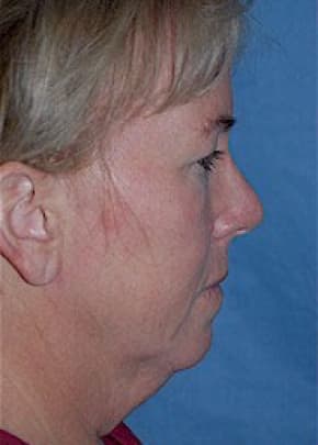 Facelift and Necklift Before & After Patient #1730