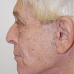 Facelift and Necklift Before & After Patient #1729