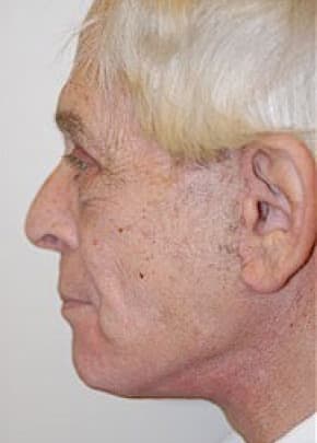Facelift and Necklift Before & After Patient #1729
