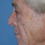 Facelift and Necklift Before & After Patient #1729