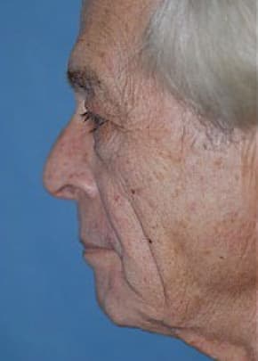Facelift and Necklift Before & After Patient #1729