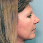 Facelift and Necklift Before & After Patient #1728