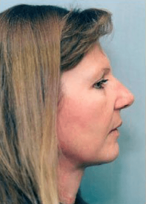 Facelift and Necklift Before & After Patient #1728