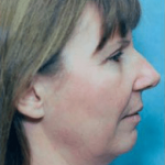 Facelift and Necklift Before & After Patient #1728