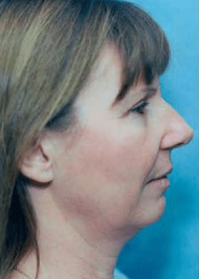 Facelift and Necklift Before & After Patient #1728