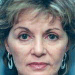 Facelift and Necklift Before & After Patient #1727