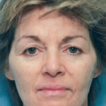 Facelift and Necklift Before & After Patient #1727
