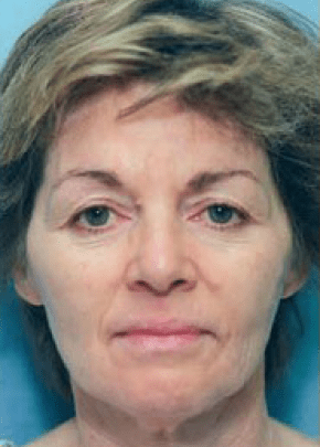 Facelift and Necklift Before & After Patient #1727