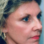 Facelift and Necklift Before & After Patient #1726