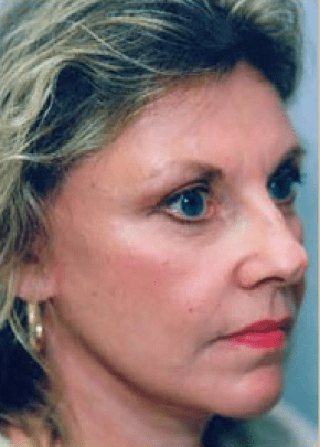 Facelift and Necklift Before & After Patient #1726
