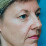 Facelift and Necklift Before & After Patient #1726